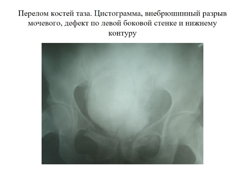 Перелом костей таза. Цистограмма, внебрюшинный разрыв мочевого, дефект по левой боковой стенке и нижнему